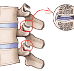 Artritis y ejercicios para la columna vertebral
