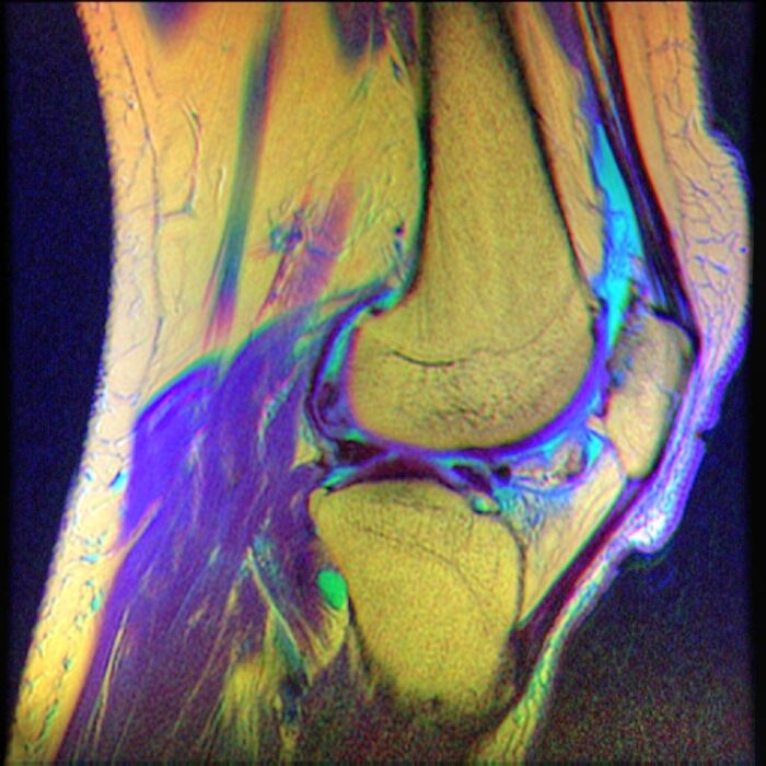 Imágenes de resonancia magnética de la rodilla que muestran condromalacia rotuliana.