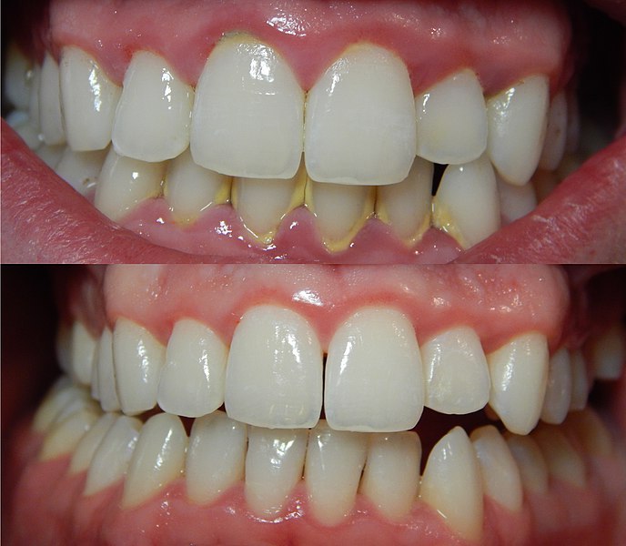 Gingivitis antes (arriba) y después (abajo) de un detallado desbridamiento (aseo) mecánico de los dientes.