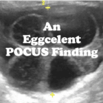 Un hallazgo de Eggcelent POCUS — USF Emergency Medicine
