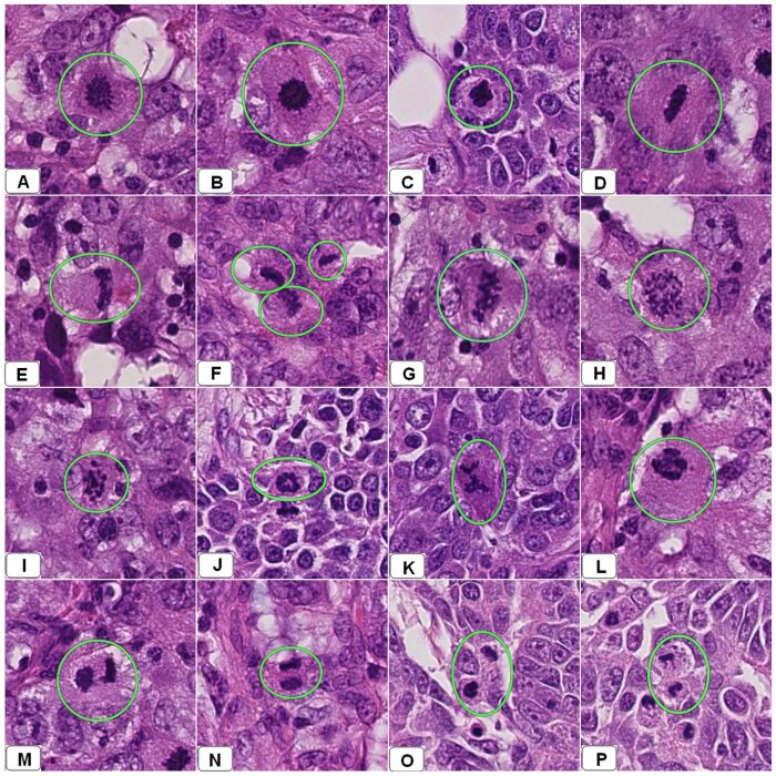 Instantáneas de varios WSI de varias resecciones mamarias diagnosticadas previamente como un carcinoma ductal infiltrativo utilizando un microscopio óptico.  Estos instantes muestran diferentes apariencias de figuras mitóticas rodeadas por círculos verdes.  Los paneles A – C muestran células en metafase tempranas.  Los paneles DG muestran diferentes formas de división mitótica en la metafase tardía.  El panel H – L muestra diferentes formas de anafase.  Los paneles M – P muestran células en telofase.
