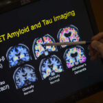 La beta amiloide causa la enfermedad de Alzheimer o hay algo