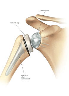 Artritis de hombro Desgarros del manguito rotador Dolor