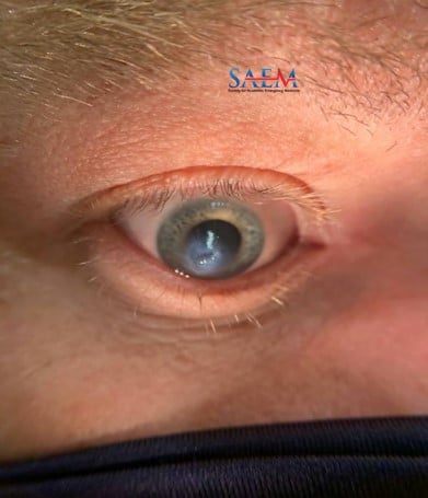 Serie de imagenes clinicas del SAEM Mi ojo se ve